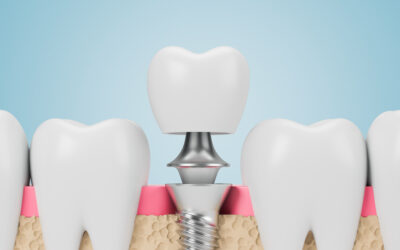 Have questions about dental implants? We have answers!