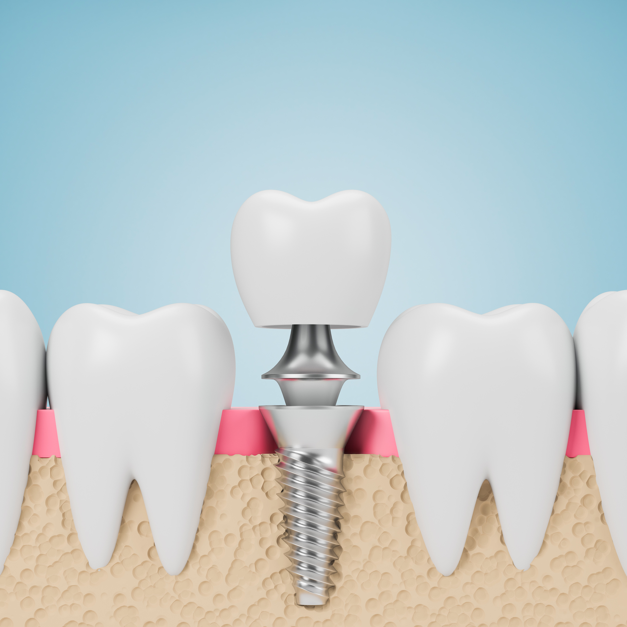 Row of teeth with dental implant screw over blue background. Concept of dental hygiene and care. 3d rendering
