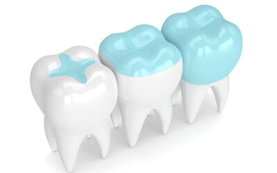 Understanding Dental Inlays: How They Differ from Fillings and Crowns
