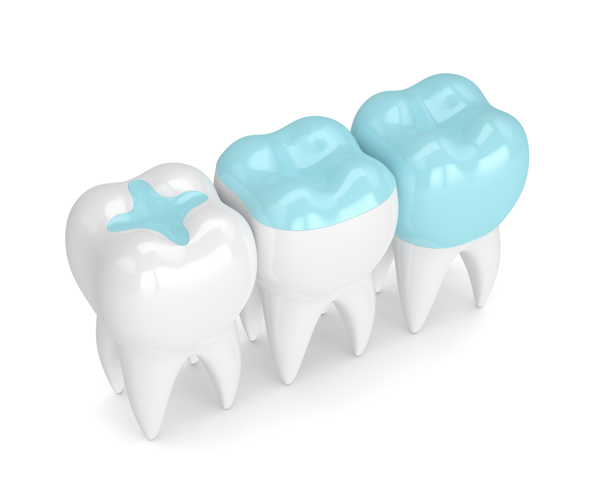 3d render of teeth with inlay, onlay and crown filling over white background
