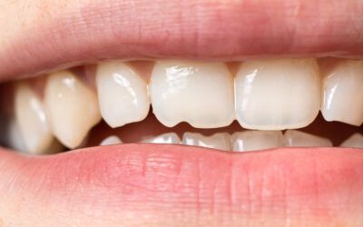 Top 5 Signs You Might Need Dental Bonding